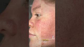 Traitement rosacée DERMALUX dermalux rosacea beauty skincare ledtherapy beauty [upl. by Kevan]