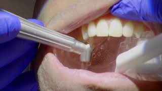 Solea Laser Dental Fillings Without Anesthesia at Fantarella Dental Group [upl. by Rahas]