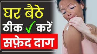 Home Remedies for Vitiligo  Safed Daag ka Ilaaj in Hindi  Gharelu Upay [upl. by Viscardi]