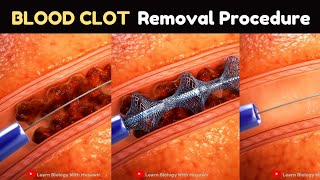 Blood Clot Removal Procedure  Medical Animation [upl. by Ahslek]