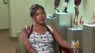 Woman Dismembered By Boyfriend In Guyana Receives New Arms Hands « CBS New York [upl. by Nodgnal]