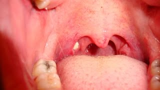 Tonsil Stones  How to Remove Tonsil Stones [upl. by Atnamas]