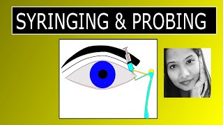 Lacrimal Syringing amp Probing  Procedure amp Interpretation of Results [upl. by Niuqauj846]