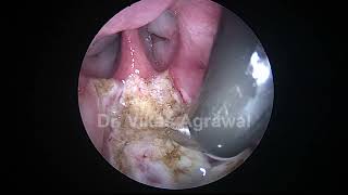 Coblation adenoidectomy in 25 yr child part 1 [upl. by Anirtruc]