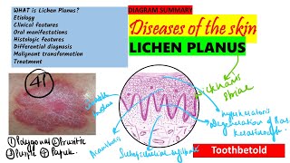 Oral Lichen planus Part 1 Causes Pathogenesis Clinical features Skin lesions [upl. by Herc856]