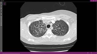 Linfangite carcinomatosa CT [upl. by Esilahc]