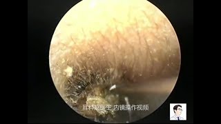 Ear canal treatment for childrens external ear canal by ear endoscope 12 minutes [upl. by Lener]