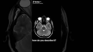 radiology التشخيصالطبي radiologylife masticator temporalis hemangioma venous malformation [upl. by Edric]