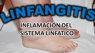 LINFANGITIS  INLFMACION DEL SISTEMA LINFATICO [upl. by Uyekawa]