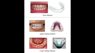 All about RETAINERS [upl. by Knutson]