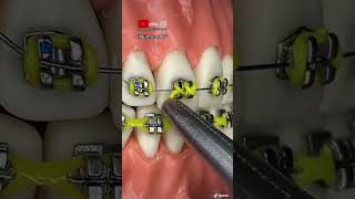 “Combinación de formas y figuras con ligas amarillas 🟡en los BRACKETS metálicos” [upl. by Formica]