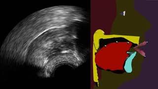 Echographie linguale augmentée pour la rééducation orthophonique [upl. by Aiym]
