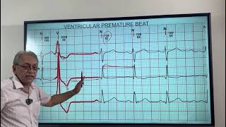 VENTRICULAR ECTOPICS  VENTRICULAR PREMATURE BEATS HOW TO DIAGNOSE ON ECG [upl. by Nnylrac430]