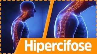 EXERCÍCIOS PARA HIPERCIFOSE DE MUSCULAÇÃO Fisioprev com Guilherme Stellbrink 1 Parte [upl. by Katharyn]