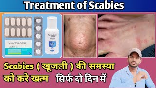 Treatment of scabiesखाज खुजली की समस्या को करें दो दिन के खत्म [upl. by Kelbee]