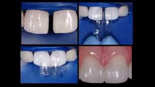 Bioclear  Diastema Closure [upl. by Banebrudge]