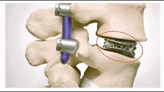 Deciding Optimal Cages for Trans Foraminal Lumbar Interbody Fusion TLIF [upl. by Jermyn]