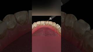 Dental Scaling Procedure medicalanimation health shorts [upl. by Randi]