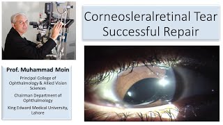 Corneoscleralretinal tear How to achieve successful outcome [upl. by Joella]