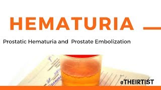 Prostate Hematuria  Blood in urine and PAE  prostate artery embolization [upl. by Eveivenej]