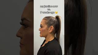 Chin lipo results 🔥chinlipo chinliposuction glowup beforeandafter weightloss jawline [upl. by Attenrad]