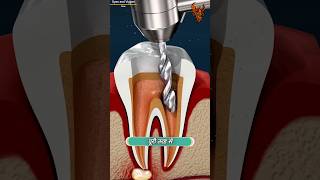 How Root Canal Works 😯  रूट कैनाल कैसे काम करता है  shorts [upl. by Nortyad]