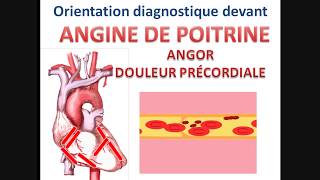 Syndrome coronarien aigu ANGINE DE POITRINE angor stable instable cours cardiologie conduite à tenir [upl. by Noissap]