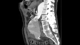 Aortic Aneurysms amp Marfans Syndrome Learn All about Potentially LifeThreatening Aortic Aneurysms [upl. by Aldin]