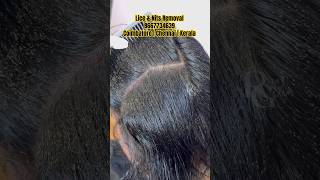 Lice removal clinichow to get rid of licelice treatmentlice removal treatment in Coimbatorelice [upl. by Irtak403]