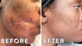 Clearing My Hormonal Acne With Spironolactone  Skin Update 3 [upl. by Banna]