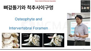 뉴만 기능해부학척추편 기초 뼈겉돌기와 척추사이구멍 osteophyte and intervertebral foramen [upl. by Norris]