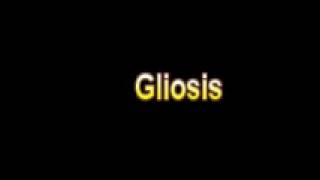 What Is The Definition Of Gliosis  Medical Dictionary Free Online Terms [upl. by Ahcsap]