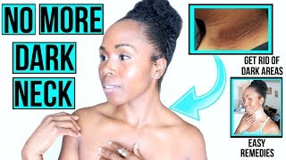 HOW TO GET RID OF DARK NECK FAST amp NATURALLY  LIGHTENING amp BRIGHTENING Home Remedies [upl. by Tiertza]