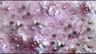 cystic acne treatment big acne removal compilation [upl. by Repooc461]