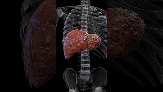 🟡 Understanding Liver Cirrhosis The Silent Damage 🟡 [upl. by Nonah]