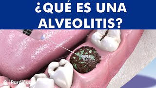 ALVEOLITIS DENTAL  Infección tras extracción de muela causas y tratamiento © [upl. by Darwen456]