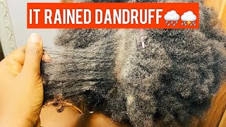 SCRATCHING THE DRIEST SCALP FOR STRESS RELIEF  ASMR [upl. by Undis353]