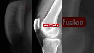 Joint Effusion of the Knee kneepain bones medical [upl. by Ddet996]