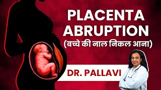 Placenta Abruption Causes Symptoms Diagnosis amp Treatment  Explained in Hindi  Abruptio Placentae [upl. by Joella]