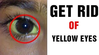 How to Get Rid of Yellow EyesTreatments and Natura Remedies [upl. by Armilda]