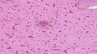 Histopathology Brain Viral encephalitis [upl. by Nagap]