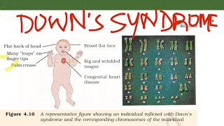 Downs Syndrome21st trisomy [upl. by Sirah]