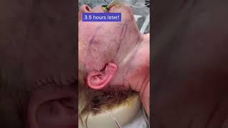 Ever Wonder what Happens During a Facelift Watch This and See facelift viral [upl. by Tini668]