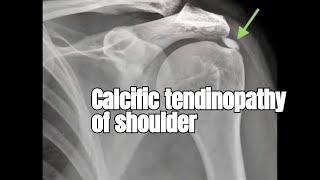 Rotator Cuff Calcific Tendinopathy  Everything You Need To Know [upl. by Hannah]