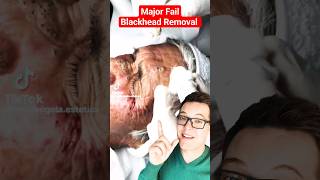 OMG Worst BLACKHEAD REMOVAL 2024  Fail shorts [upl. by Oderfodog]