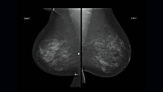 Breast Tomosynthesis Current State of the Art [upl. by Idak103]