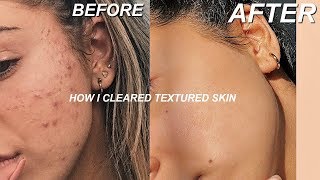 HOW I GOT RID OF TEXTURED SKIN  TIPS FOR CLEAR SKIN [upl. by Gwenny269]