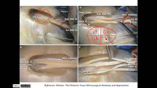 Neurosurgery anatomy of the cerebellopontine angle Facial nerve landmarks [upl. by Gibbs]