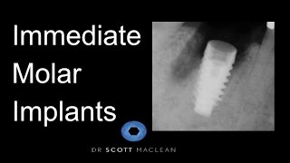 ASC Abutment  Why on an implant molar  Dr Scott MacLean [upl. by Urbano]