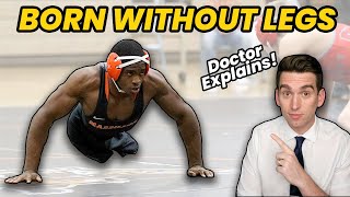 Born WITHOUT LEGS Doctor Explains INSPIRING Story of Zion Clark [upl. by Lienad876]